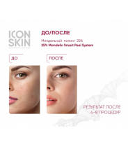 Пилинг миндальный 25% / Smart 25 % Mandelic Peel System 30 мл