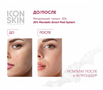 Пилинг миндальный 25% / Smart 25 % Mandelic Peel System 30 мл