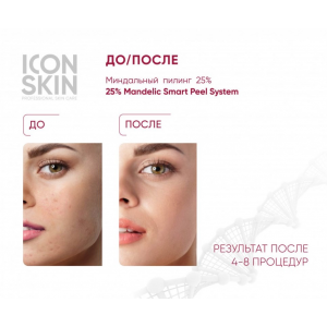 Пилинг миндальный 25% / Smart 25 % Mandelic Peel System 30 мл